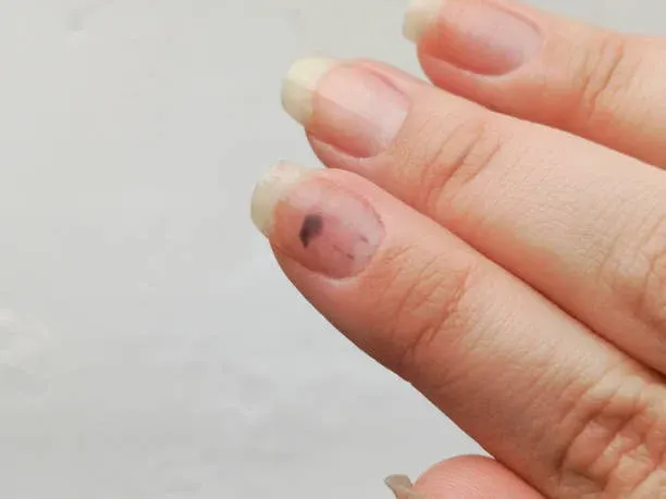 손톱이 두꺼워지고 색이 변한다면 ‘조갑백선’ 의심해야