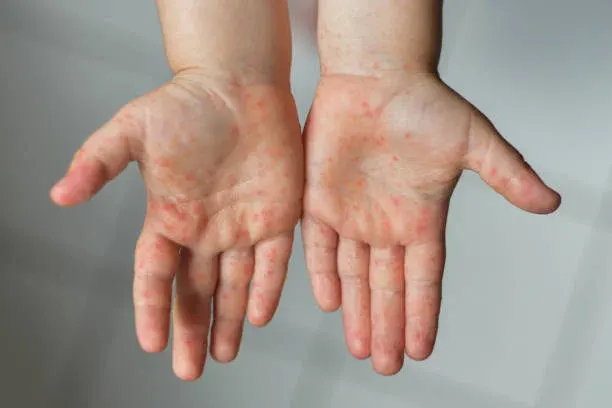 여름철 영유아에게 늘어나는 수족구병, 입안 물집과 손발 발진을 놓치지 말아야