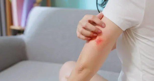 여름 모기 물림 가볍게 보면 안 된다, 웨스트나일바이러스 감염 주의