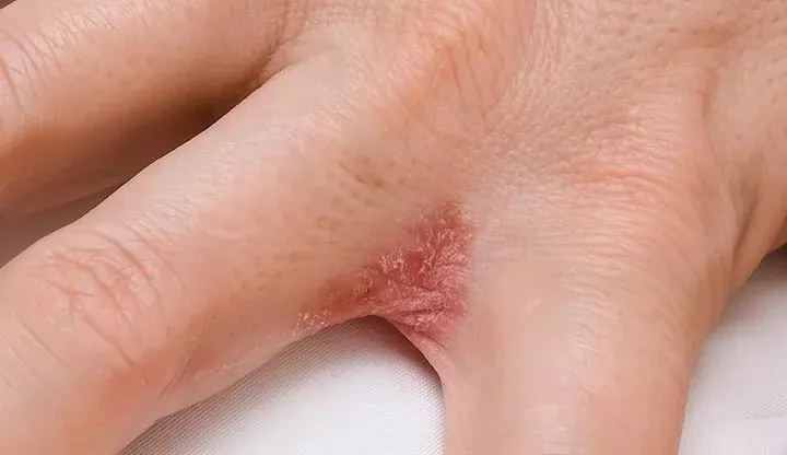 주부습진 아닌데 여름마다 물집, 한포진을 의심해볼 때