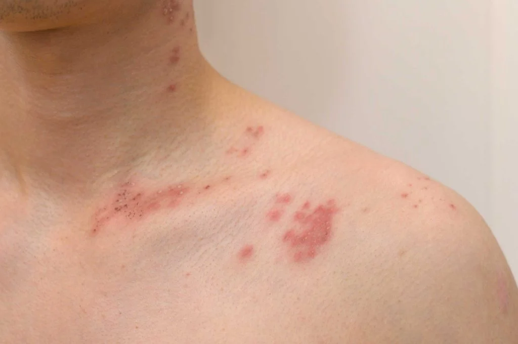 대상포진, 골든타임 놓치면 통증이 오래 남는 이유