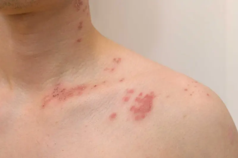 대상포진, 골든타임 놓치면 통증이 오래 남는 이유