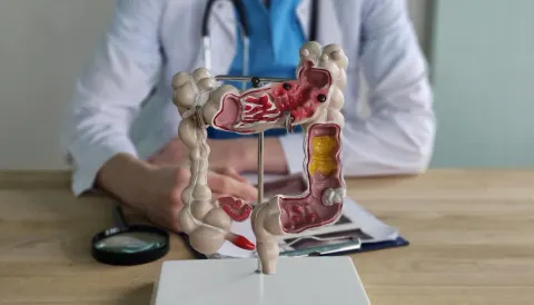 젊은 층 대장암 증가, 식생활만으로 설명할 수 없는 이유