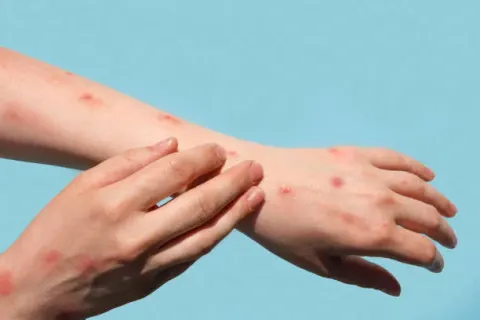 여행 전 원숭이두창 유행 지역 확인, 발진과 림프절 부종 놓치면 안 된다