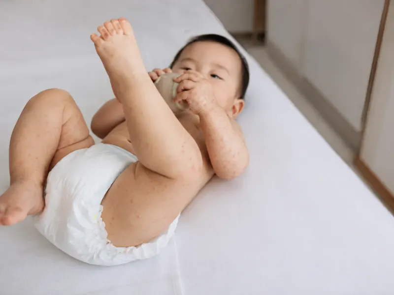 수족구병 한 달 새 2배 증가, 입안 통증과 손발 발진 살펴야