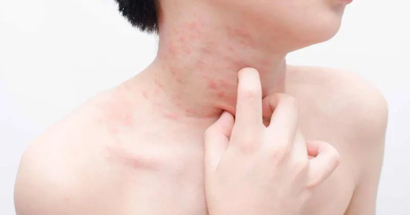 피부 가려움 6주 넘으면 만성두드러기일까 팽진 동반 여부가 핵심