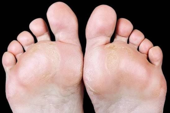 발바닥 굳은살, 단순히 많이 걸어서 생기는 게 아니다