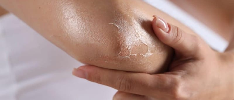 건조한 환절기, 보습크림 듬뿍 발라도 가려운 이유 피부 건조만의 문제 아닐 수도