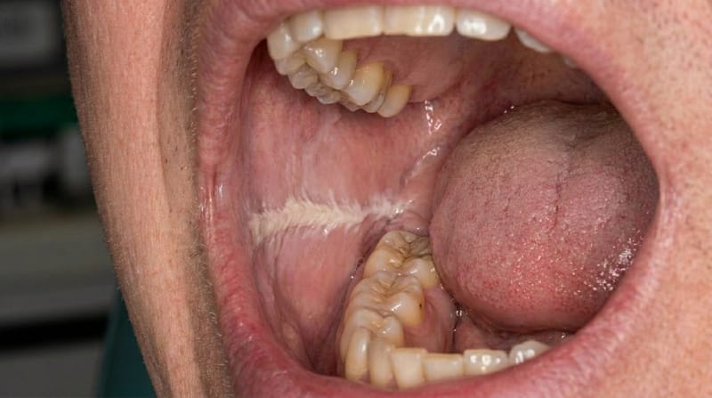 밥 먹을 때마다 볼살·입술 안쪽 깨문다면? 반복되는 입안 상처의 원인