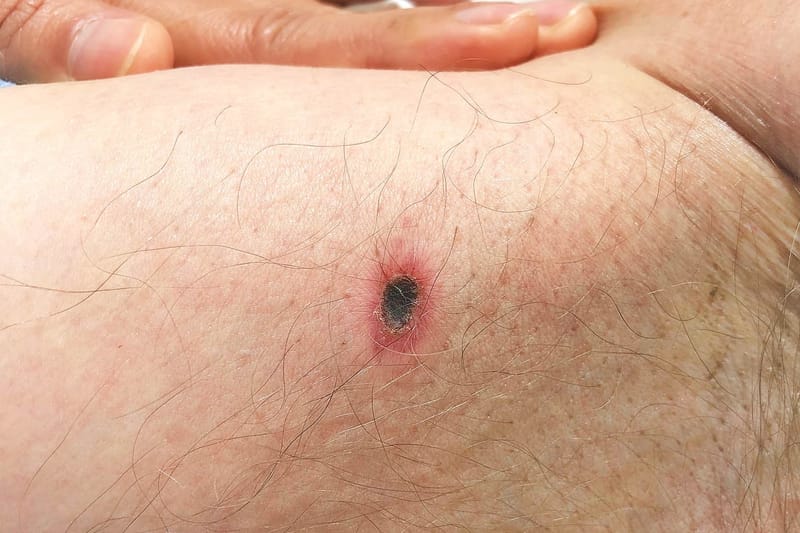 환절기 갑자기 열나고 피부에 검은 딱지 생겼다면 ‘쯔쯔가무시증’ 의심해야