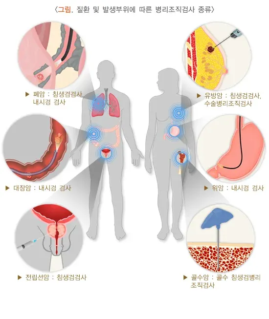 병리조직검사 검사 항목 설명 이미지 1