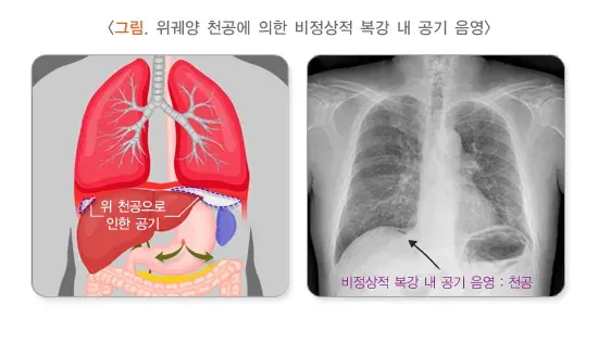 복통 진단 및 검사 설명 이미지 2