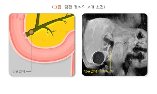복통 관련 질환 설명 이미지 2