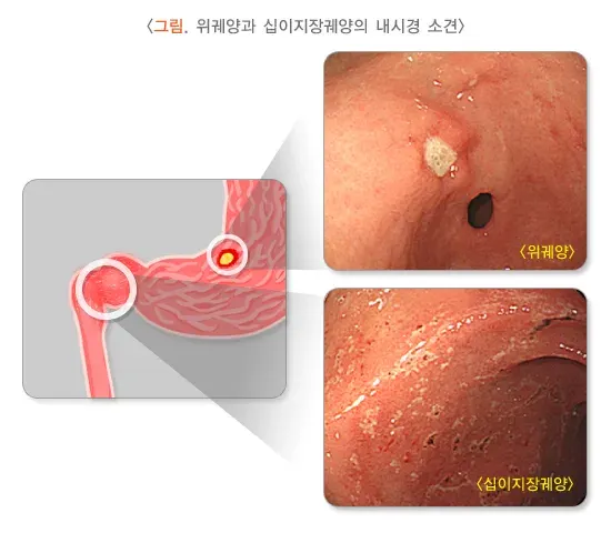 복통 관련 질환 설명 이미지 3