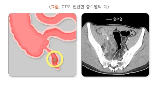 복통 관련 질환 설명 이미지 1