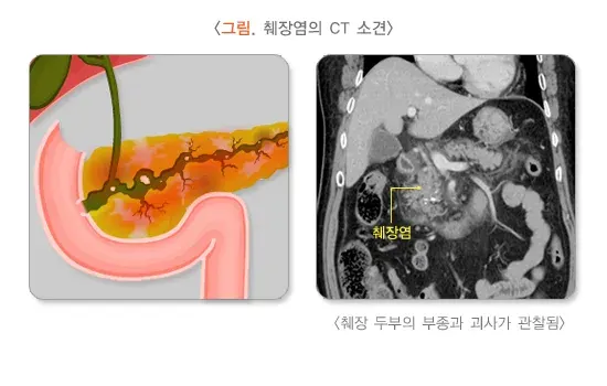 복통 관련 질환 설명 이미지 5