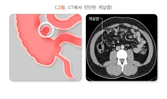 복통 관련 질환 설명 이미지 4