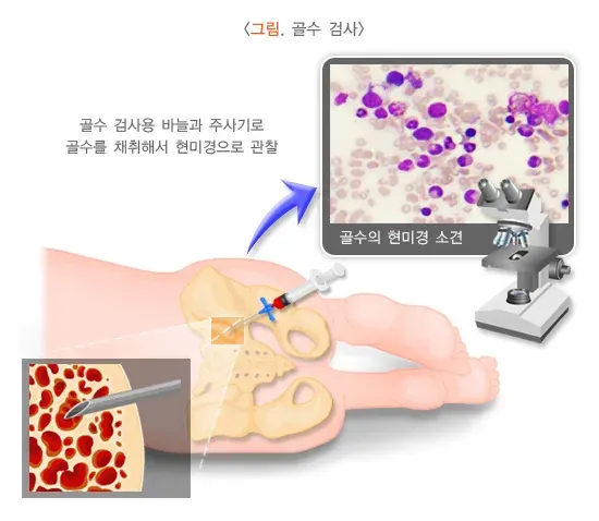 빈혈 진단 및 검사 설명 이미지 2