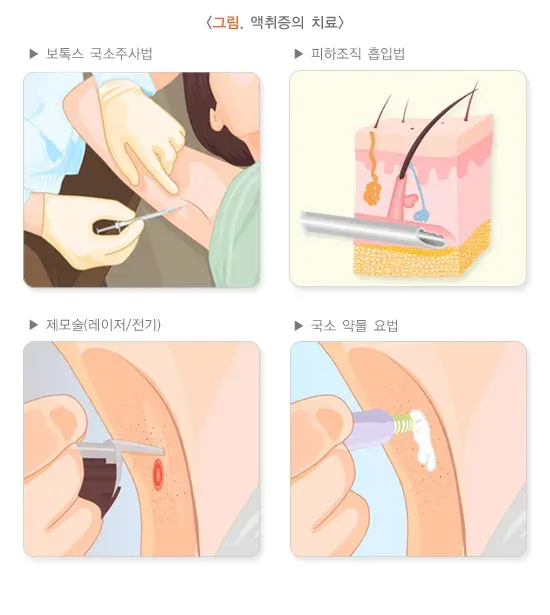 액취증 치료 설명 이미지 1