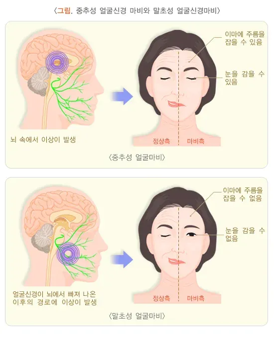 얼굴마비 증상 설명 이미지 1
