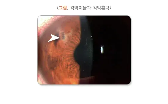 각막혼탁 및 반흔 원인 설명 이미지 2