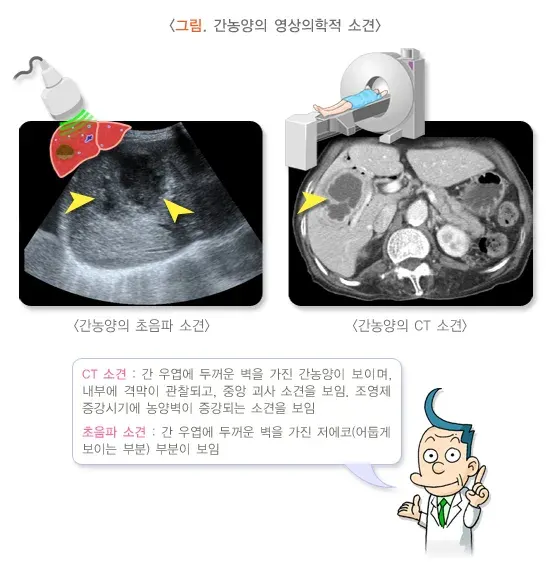 간농양 진단 및 검사 설명 이미지 1