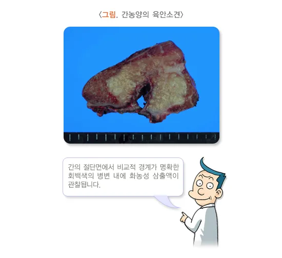 간농양 진단 및 검사 설명 이미지 2