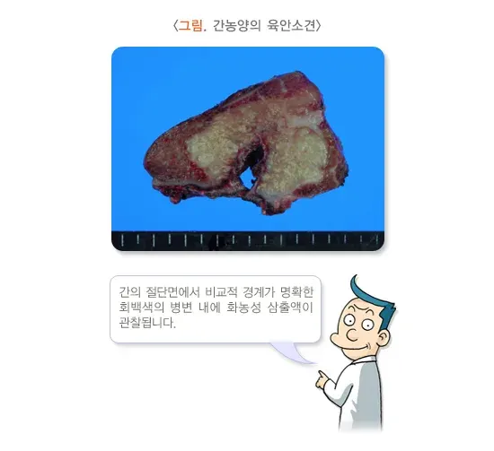 간농양 진단 및 검사 설명 이미지 2