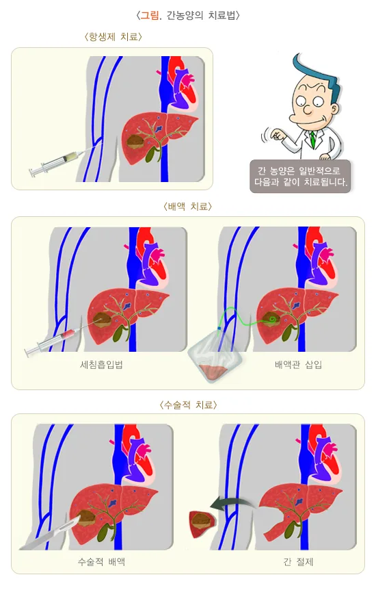 간농양 치료 설명 이미지 1