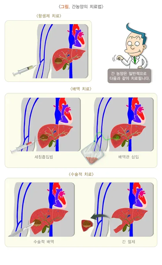 간농양 치료 설명 이미지 1