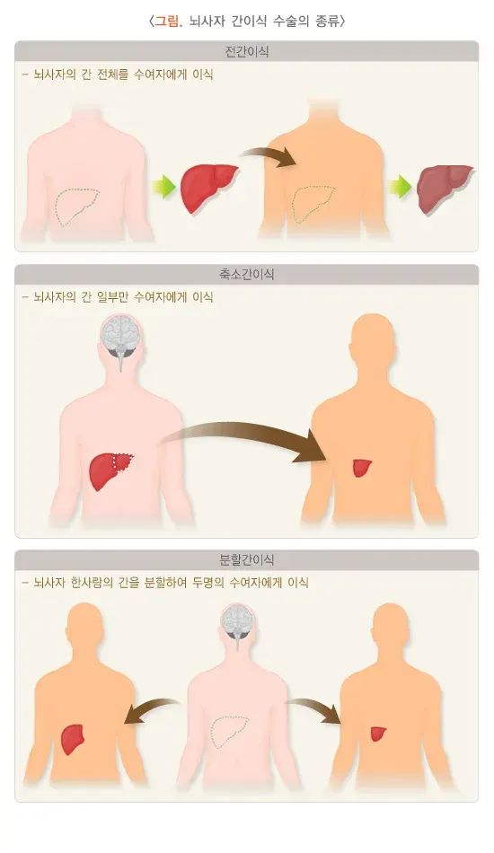 간이식수술 치료 방법 설명 이미지 1