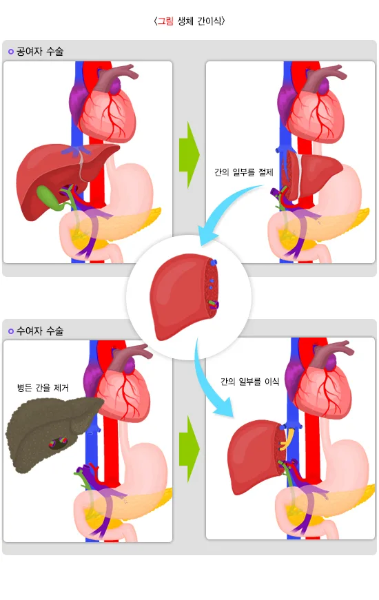 간이식수술 치료 방법 설명 이미지 4