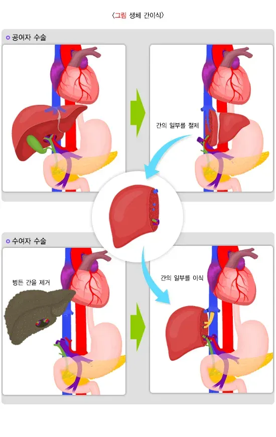 간이식수술 치료 방법 설명 이미지 4