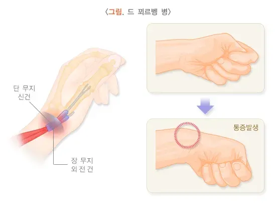 건막염 종류 설명 이미지 2