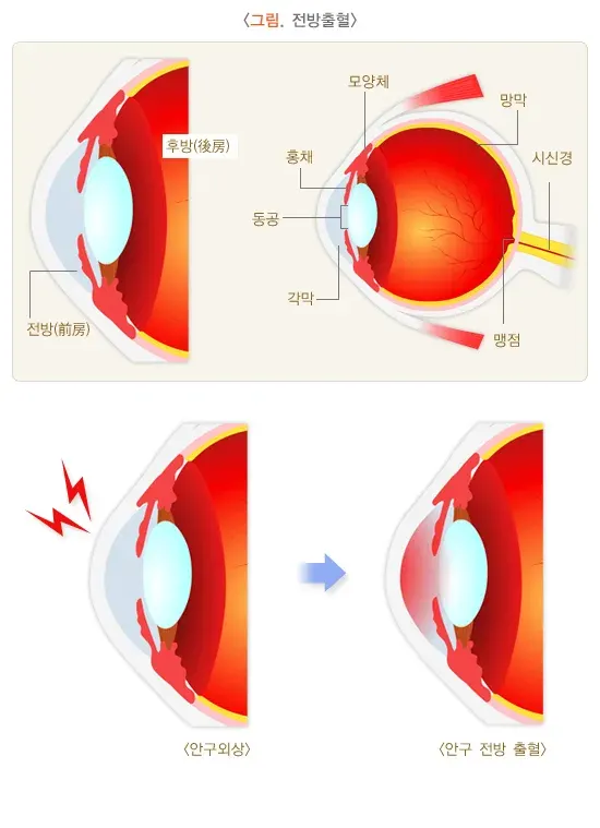 안외상(전방출혈) 정의 설명 이미지 1