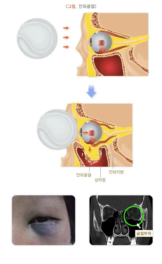안외상(안와골절) 증상 설명 이미지 1