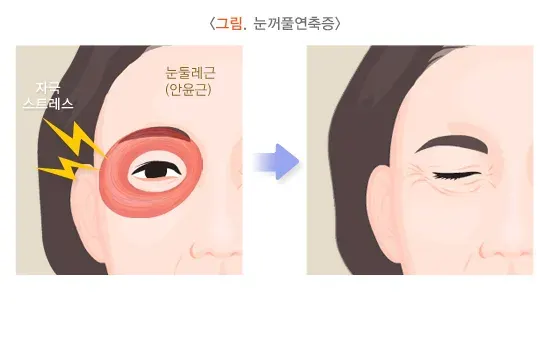 얼굴떨림(얼굴연축_눈꺼풀연축) 병태생리 설명 이미지 1