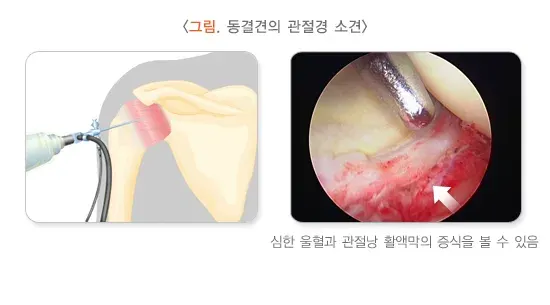 오십견 비약물 치료 설명 이미지 5
