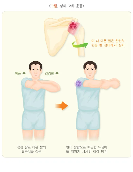 오십견 비약물 치료 설명 이미지 4
