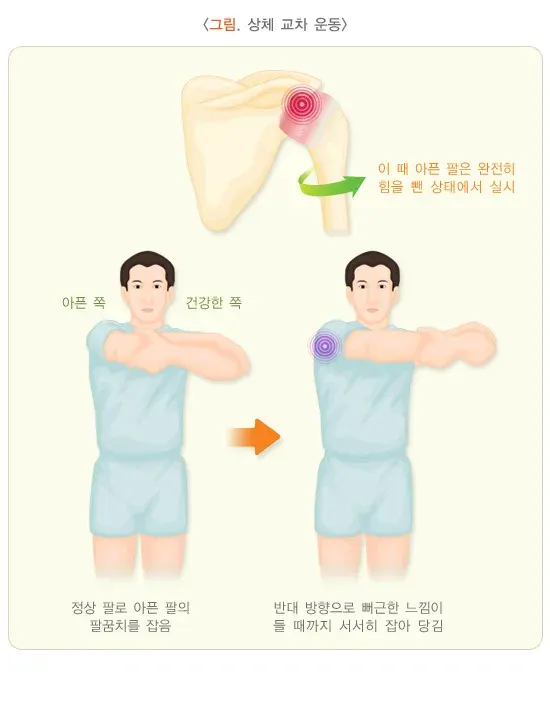 오십견 비약물 치료 설명 이미지 4