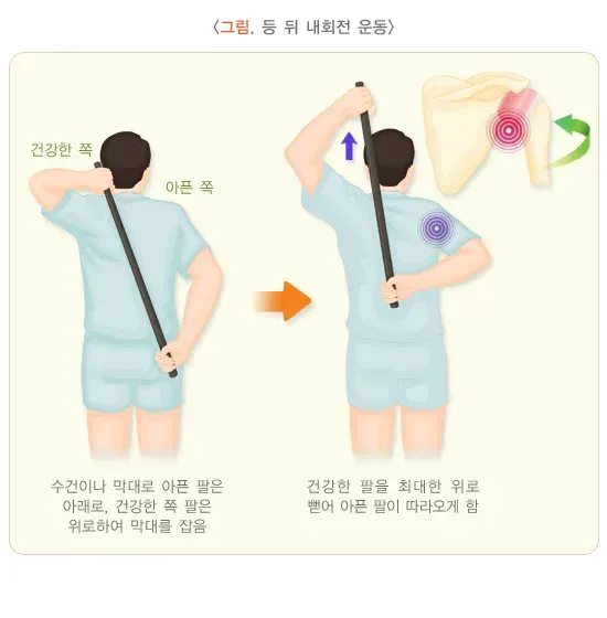오십견 비약물 치료 설명 이미지 3