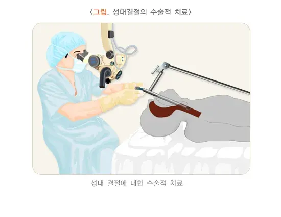 성대결절 비약물 치료 설명 이미지 1