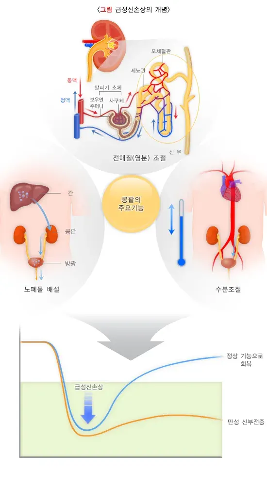 급성신손상(소아) 정의 설명 이미지 1