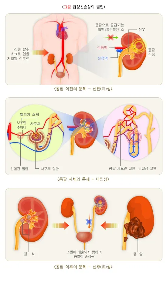 급성신손상(소아) 병태생리 설명 이미지 1