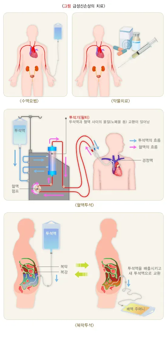 급성신손상(소아) 치료 설명 이미지 1