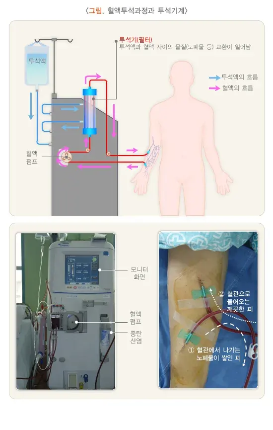 급성신손상(소아) 비약물 치료 설명 이미지 1
