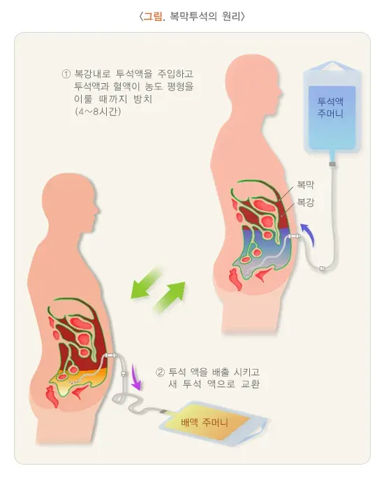 급성신손상(소아) 비약물 치료 설명 이미지 2