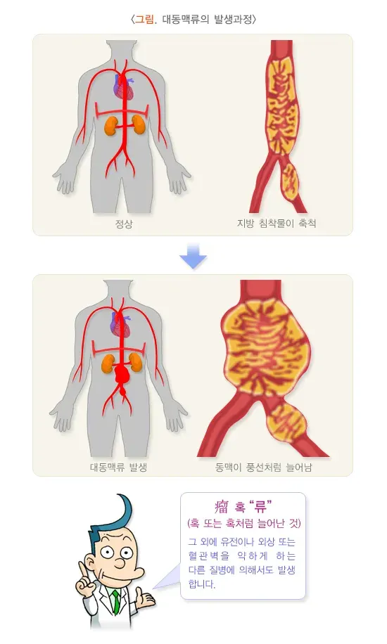 대동맥류 정의 설명 이미지 1