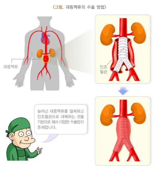 대동맥류 비약물 치료 설명 이미지 1