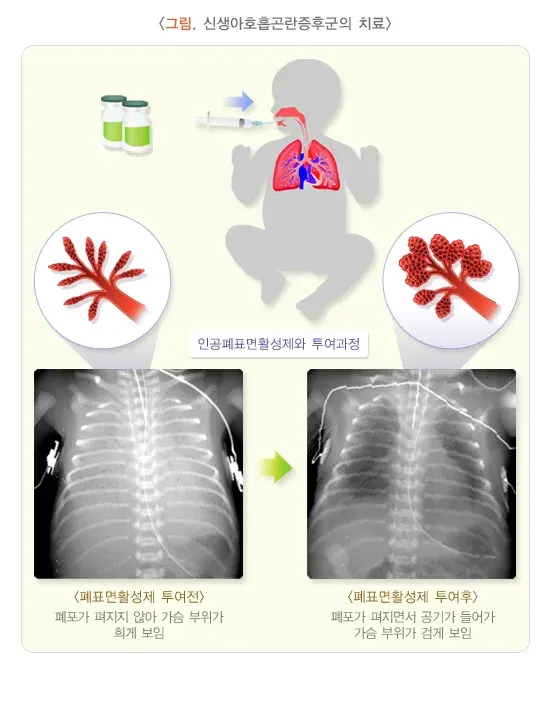 미숙아 합병증 설명 이미지 2
